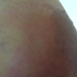 Plano Orthopedic & Sports Medicine Center - Bubbly burned elbow