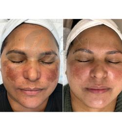 Best & Beyond Spa - Spots / Melasma treatment