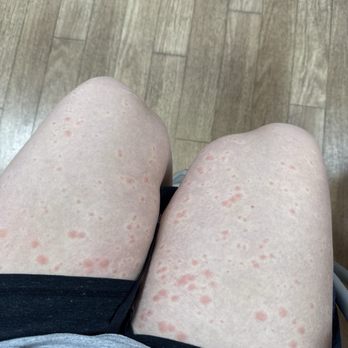 Solara Inn and Suites - Allergic reaction to the sheets - Hotels Near Me - Anaheim, California