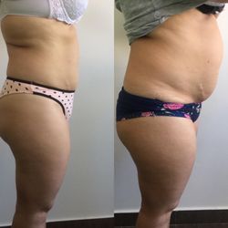Holistic Health and Laser Hair Removal Clinic - Alma vShape and Mesotherapy