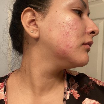 PS Skincare - Before: Red, Inflammed, Painful!!! - Skin Care Near Me - La Jolla, California PS Skincare - Before: Red, Inflammed, Painful!!! - Skin Care Near Me - La Jolla, California