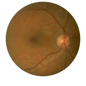 Sager Eye Care Center - The inside of my right eye. - Optometrists Near Me - Plantation, Florida