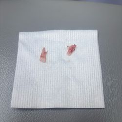 New Braunfels Podiatry Associates - Ingrown successfully taken out