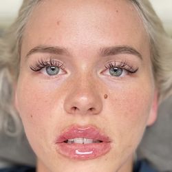 BioDesign Clinic + MedSpa - Beautiful lip filler results