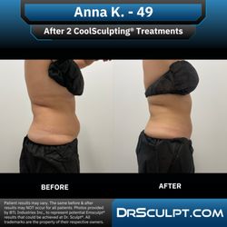 Dr. Sculpt CoolSculpting & EmSculpt Center - After 2 CoolSculpting treatments on abdomen/flanks