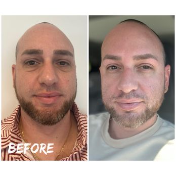 Diamond Med Spa - Botox before and after - Medical Spas Near Me - Miami Beach, Florida Diamond Med Spa - Botox before and after - Medical Spas Near Me - Miami Beach, Florida