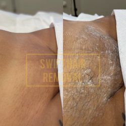 Swift Hair Removal - Get summer ready with an EXPERT BIKINI WAXING SUGARING SERVICE, leaving you smooth, confident, and ready to rock your favorite swimsuit with