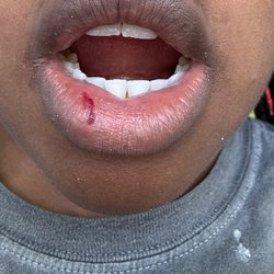 Academy Dental - The cut they gave me. Looks like I got in a fight.
