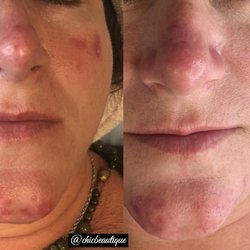 Chic Beautique Skin Clinic - Stem cell dermal infusion rosacea