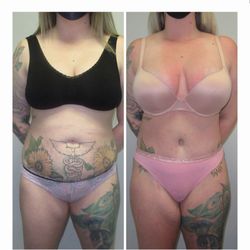 Swet Chaudhari, MD - SunCoast Plastic Surgery - Tummy TUCK