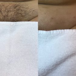 Navarro wax skin and beauty - Before and after Brazilian wax