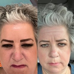Senza Aesthetic Medicine - After and before pictures of forehead Botox injections