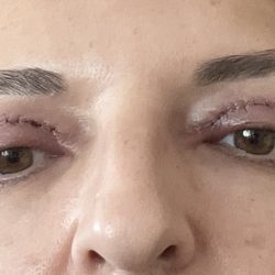 SF - This is UNEDITED photo the day after my surgery