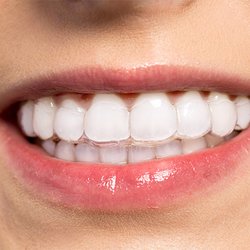 Seneca Ridge Dental - Clear Correct Aligner Therapy