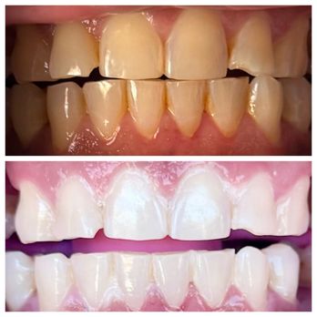 Lumiglo - Before and after of my teeth! - Teeth Whitening Near Me - Laguna Niguel, California Lumiglo - Before and after of my teeth! - Teeth Whitening Near Me - Laguna Niguel, California