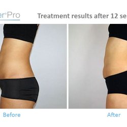 Signature Aesthetics - Visible changes after a series of Ballancer® Pro compression therapy sessions supporting lymphatic drainage and overall wellness.