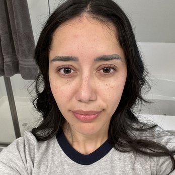 Vital Therapeutics - After Dysport (I swear I'm frowning) - IV Hydration Near Me - Newark, California Vital Therapeutics - After Dysport (I swear I'm frowning) - IV Hydration Near Me - Newark, California