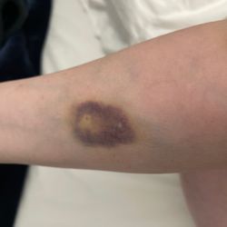 Royal Alexandra Hospital - Bruising due to blood collection RH Arm