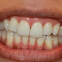 Ocean View Dental Group - Great Zoom Bleaching Results!