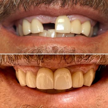 ATX Dental Studio - Dental implants replacing missing teeth. - Cosmetic Dentists Near Me - Austin, Texas