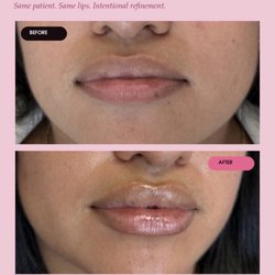 Aesthoria Aesthetics Medical Spa - 0.5ml mini pout lip filler. Patient wanted a natural result with a hydration, pout and a keyhole. RHA filler used