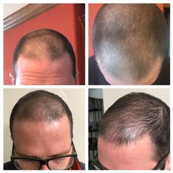 Bloom Beauty Ink - Scalp Micropigmentation is tiny dots applied to the scalp to create the allusion of hair follicles. - Permanent Makeup Near Me - Chickasha, Oklahoma Bloom Beauty Ink - Scalp Micropigmentation is tiny dots applied to the scalp to create the allusion of hair follicles. - Permanent Makeup Near Me - Chickasha, Oklahoma