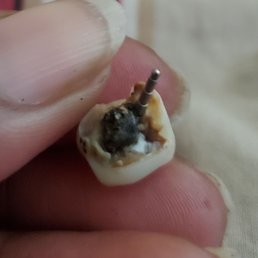 Broken tooth Broken tooth