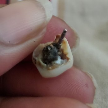 Xiao Dental - Broken tooth - General Dentistry Near Me - Livermore, California Xiao Dental - Broken tooth - General Dentistry Near Me - Livermore, California