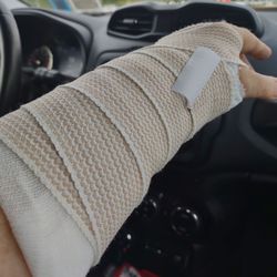 Erie County Medical Center - Better splint from specialist