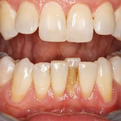 Boulder Valley Dental Center - Our patient wore braces as a teenager but didn't like the shifting years later.