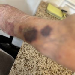 Paradise Valley Senior Living - Arm bruising unreported incident