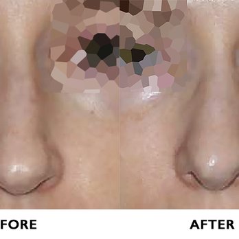 Robert Kotler, MD FACS - In trying to discredit me and my review, this is what Kotler describes as a "reasonable but not perfect" outcome. - Cosmetic Surgeons Near Me - Beverly Hills, California Robert Kotler, MD FACS - In trying to discredit me and my review, this is what Kotler describes as a "reasonable but not perfect" outcome. - Cosmetic Surgeons Near Me - Beverly Hills, California
