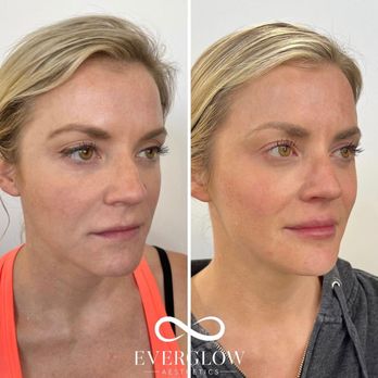 EverGlow Aesthetics - Before and after facial balancing - Medical Spas Near Me - Tustin, California