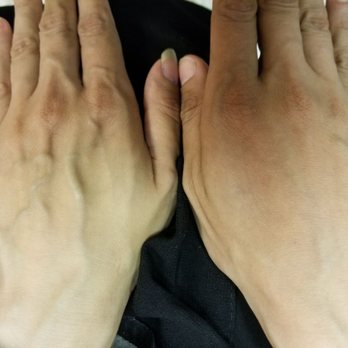 Medical Aesthetics - Hands rejuvenation with Radiesse. - Medical Spas Near Me - Brooklyn, New York Medical Aesthetics - Hands rejuvenation with Radiesse. - Medical Spas Near Me - Brooklyn, New York