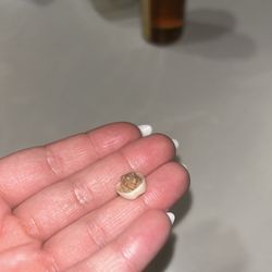 Monarch Dental & Orthodontics - Tooth attached to my crown
