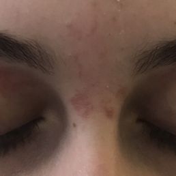 My 14 yr old daughter after an eyebrow wax. Still have not received a call back from the manager. My 14 yr old daughter after an eyebrow wax. Still have not received a call back from the manager.