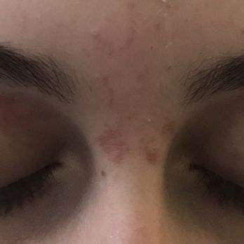 European Wax Center - My 14 yr old daughter after an eyebrow wax. Still have not received a call back from the manager. - Waxing Near Me - Edgewater, New Jersey European Wax Center - My 14 yr old daughter after an eyebrow wax. Still have not received a call back from the manager. - Waxing Near Me - Edgewater, New Jersey
