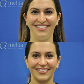 Mehta Plastic Surgery - Rhinoplasty before (top) and after (bottom) - Cosmetic Surgeons Near Me - Menlo Park, California