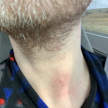 Rodeway Inn - Bed bug bites on neck, 24hrs later. Very itchy. - Hotels Near Me - Grand Island, Nebraska