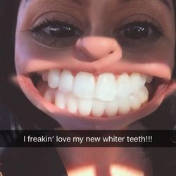 Cordano Dental - All I had was the Snapchat pic for my AFTER how fitting is this filter?! They're super white now