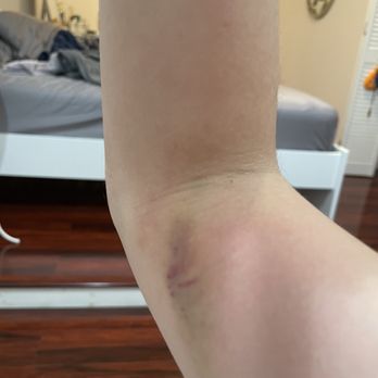 Quest Diagnostics - 1.5 weeks later, I am still bruising. - Laboratory Testing Near Me - Irvine, California Quest Diagnostics - 1.5 weeks later, I am still bruising. - Laboratory Testing Near Me - Irvine, California