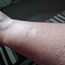 Hudson Valley Dermatology PC - Scar on my forearm