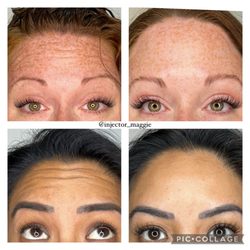 Modern Med Aesthetics & Wellness - Before and After Botox treatment