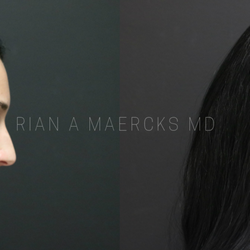 Rian A Maercks, MD - Aesthetic Facial Balancing - Before and After (Subtle aesthetic improvements to the eyes, lips and nose)