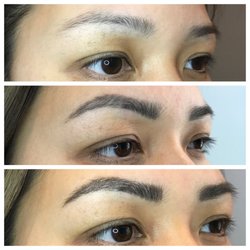 Metro Laser Coolsculpting MedSpa-Plymouth Meeting - Top-original brow, middle-first session completely healed, bottom - after perfecting session