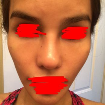 Advanced Aesthetics - 2nd pics front view (right after dissolving the filler) - Medical Spas Near Me - Las Vegas, Nevada Advanced Aesthetics - 2nd pics front view (right after dissolving the filler) - Medical Spas Near Me - Las Vegas, Nevada