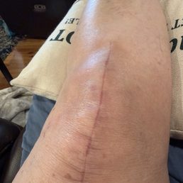 My knee replacement after 25 days! My knee replacement after 25 days!