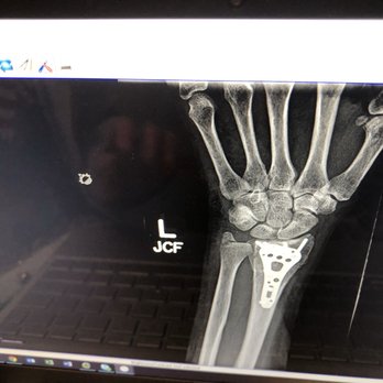 Ventura Orthopedics - Left wrist radius plate, no complications so far! - Sports Medicine Near Me - Ventura, California