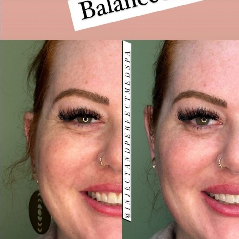 Inject and Perfect - Cheek and jawline filler - Medical Spas Near Me - Woburn, Massachusetts Inject and Perfect - Cheek and jawline filler - Medical Spas Near Me - Woburn, Massachusetts