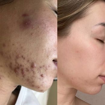Time to Shine Studio - Acne treatment with PlaSon Plasmaporation - Skin Care Near Me - Phoenix, Arizona